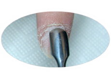 Vorbereitung des Nagels